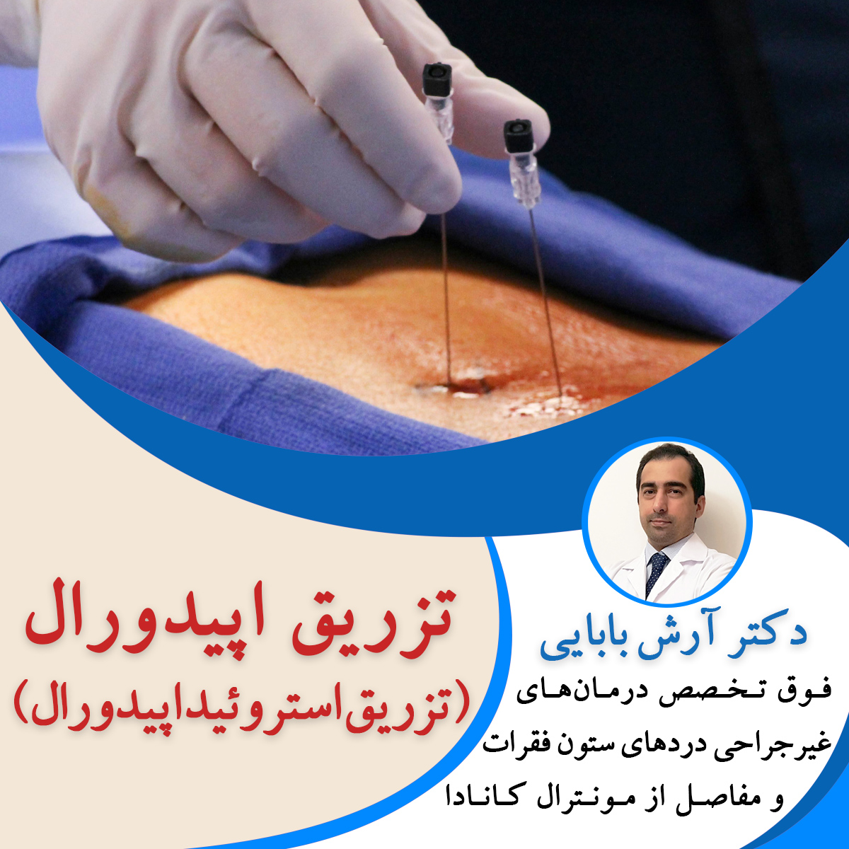 تزریق اپیدورال (تزریق استروئید اپیدورال)