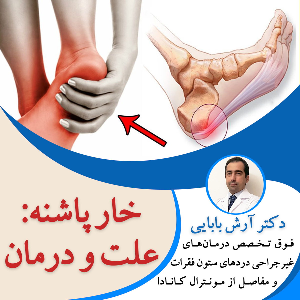 خار پاشنه، علت و درمان دکتر