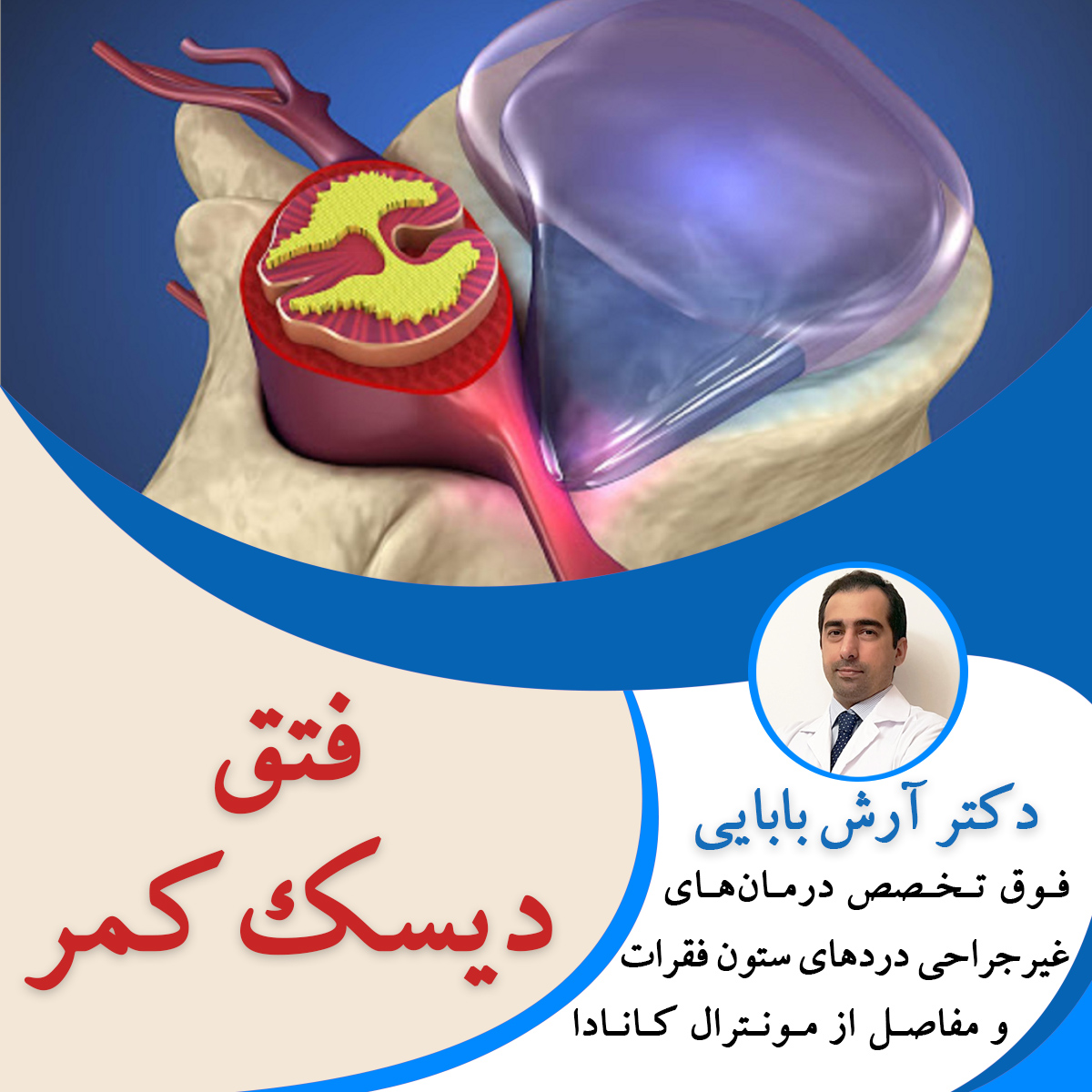فتق دیسک کمر