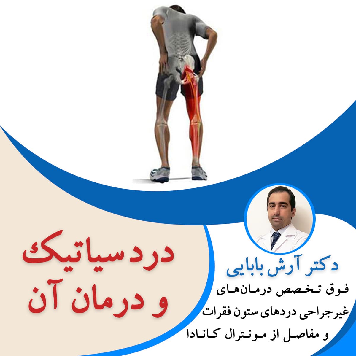 درد سیاتیک و درمان آن