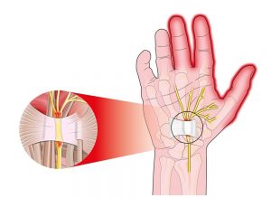 علائم سندرم تونل کارپال