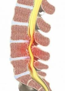 علل درد سیاتیک