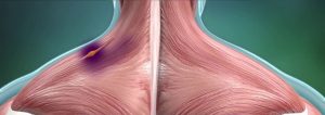 سندرم درد مايوفاشيال یا نقطه ماشه اي