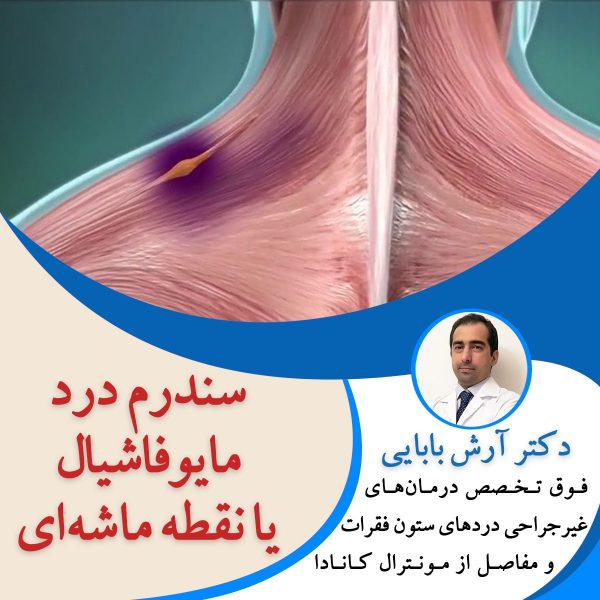 سندرم درد مایوفاشیال یا نقطه ماشه ای