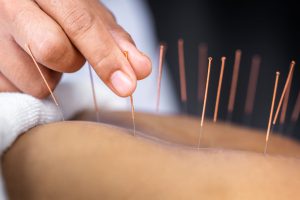 طب سوزنی