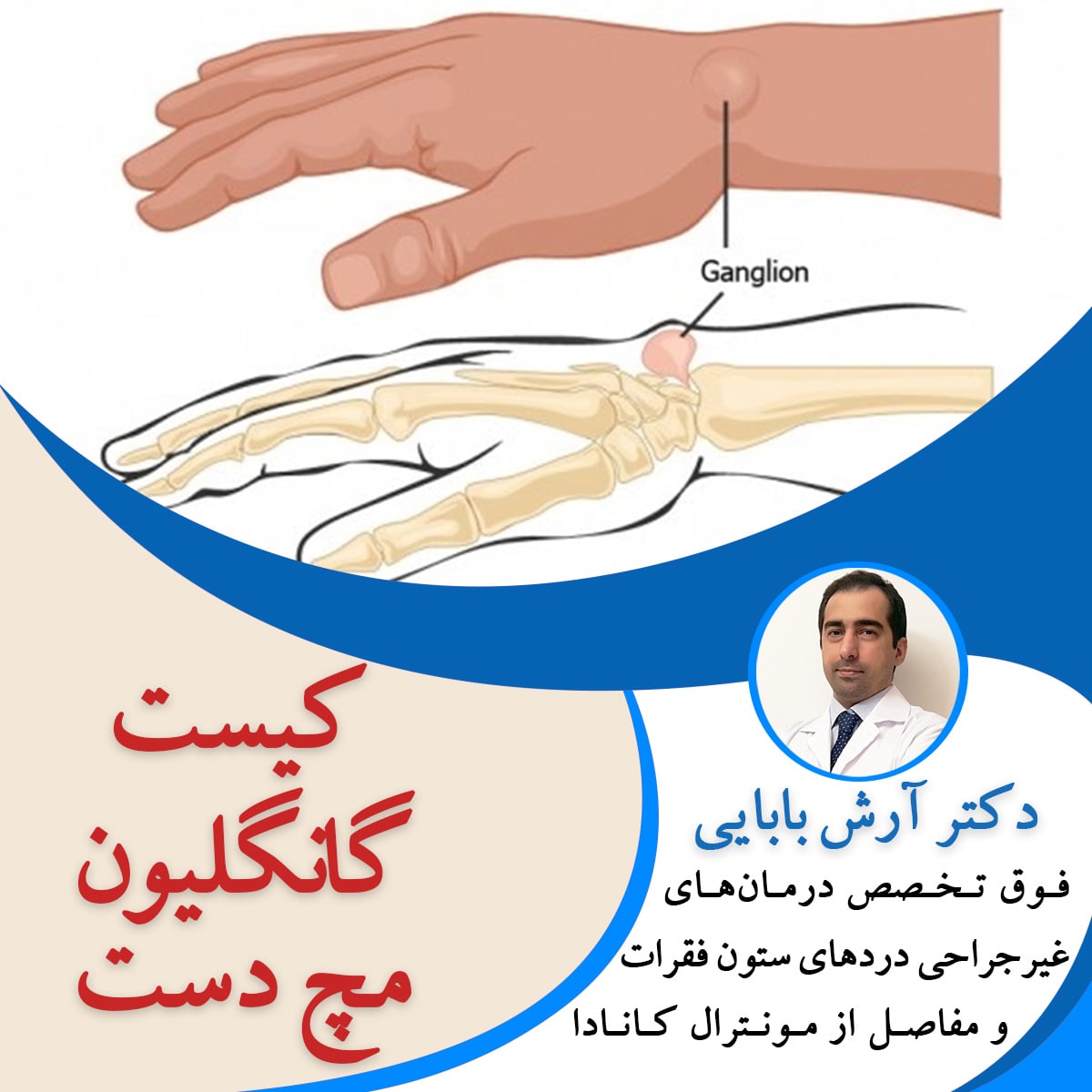 کیست گانگلیون مچ دست