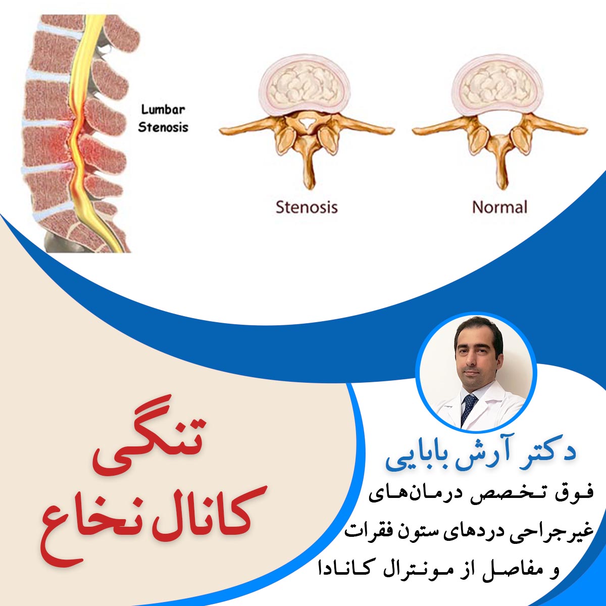 تنگی کانال نخاع