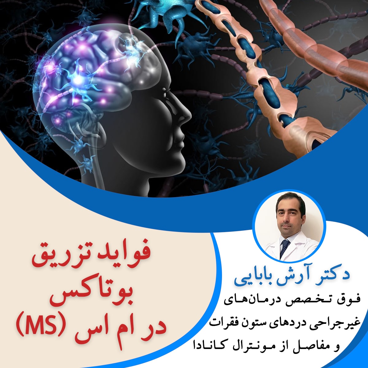 فواید تزریق بوتاکس در ام اس (MS)