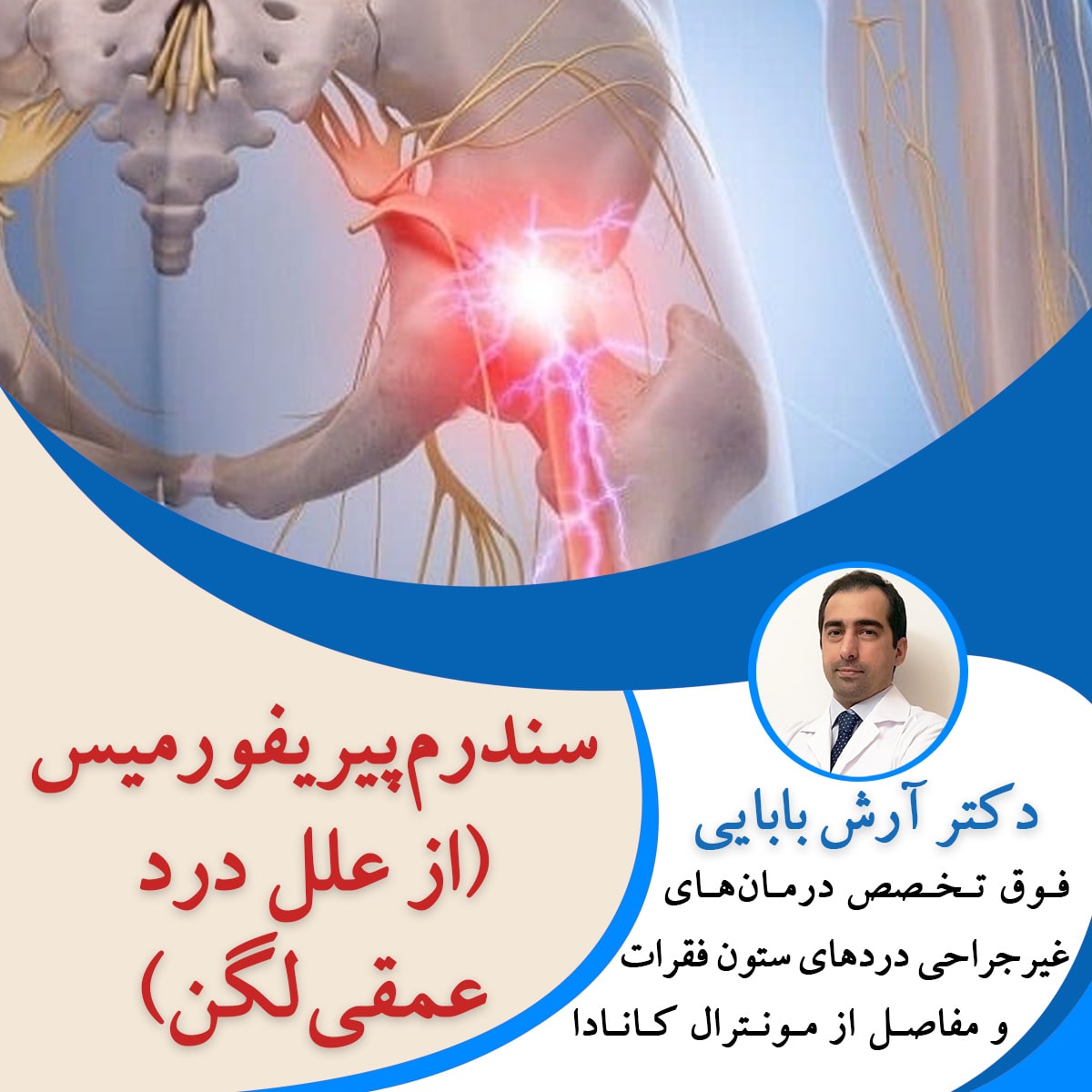 سندرم پیریفورمیس