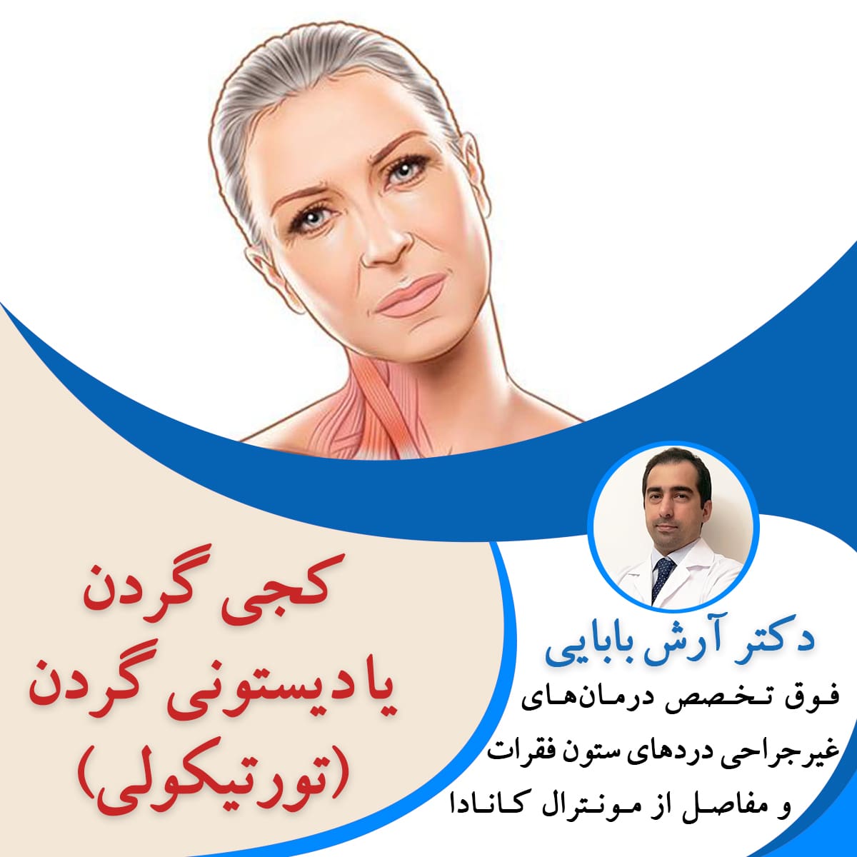 کجی گردن یا دیستونی گردن (تورتیکولی)