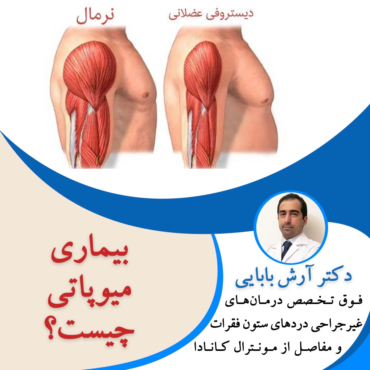 بیماری میوپاتی چیست؟