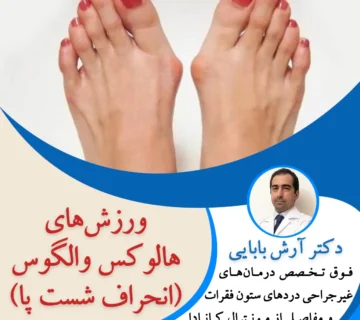 ورزش‌های هالوکس والگوس (انحراف شست پا)