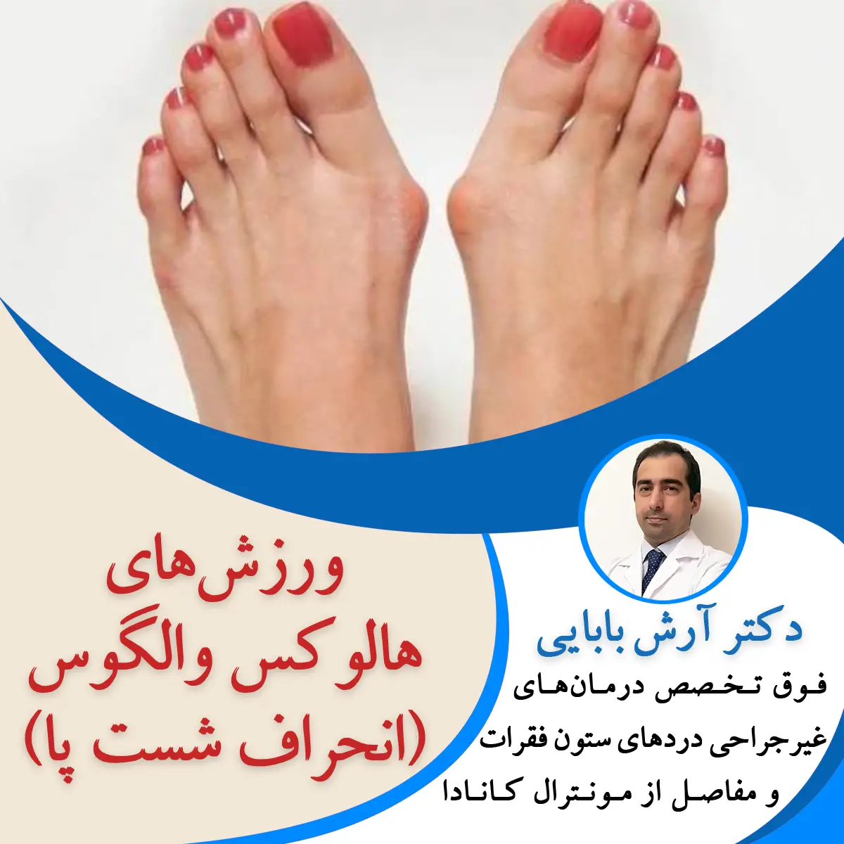 ورزشهای هالوکس والگوس (انحراف شست پا)